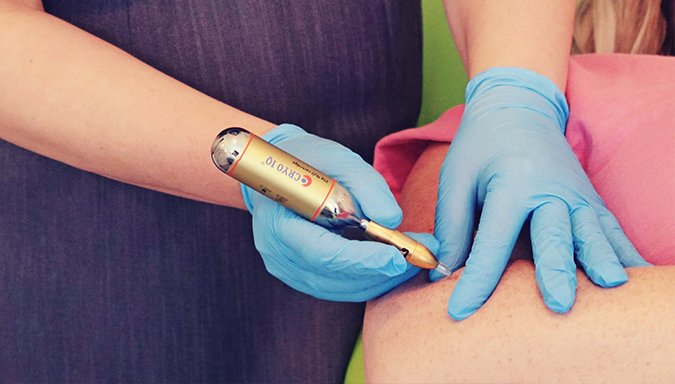 Cryotherapy treatment on a skin tag