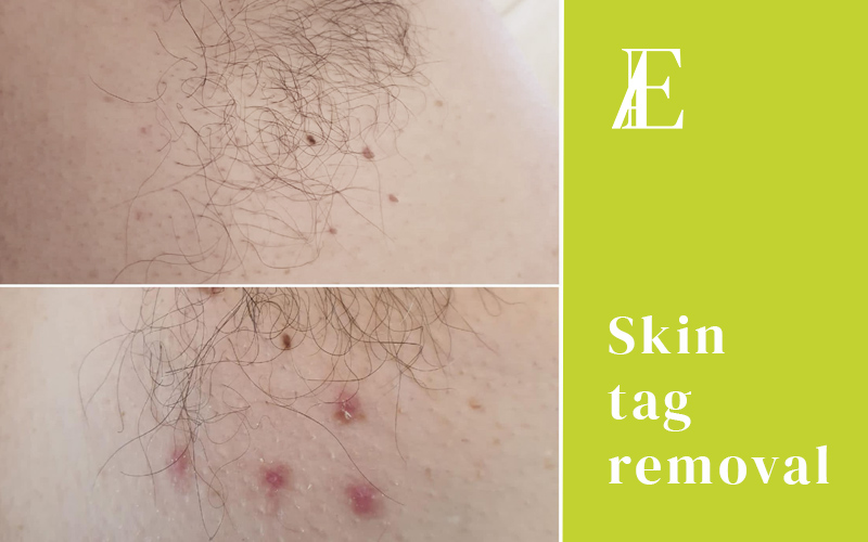skin tag removal