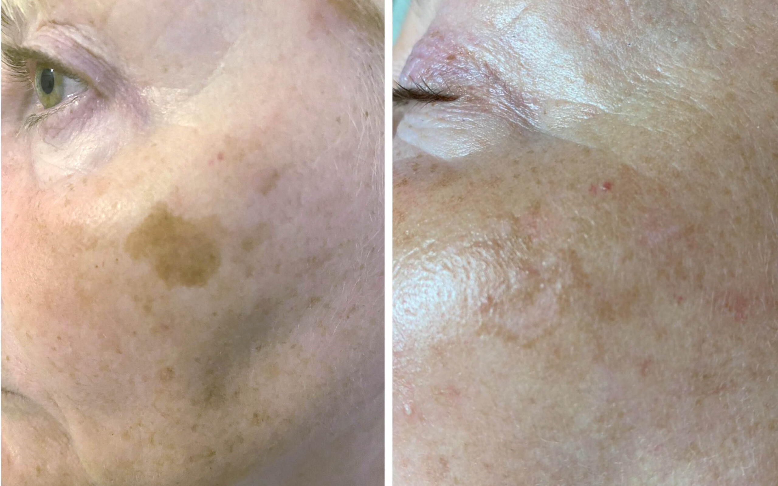 cryotheraprpy for skin damage and blemishes