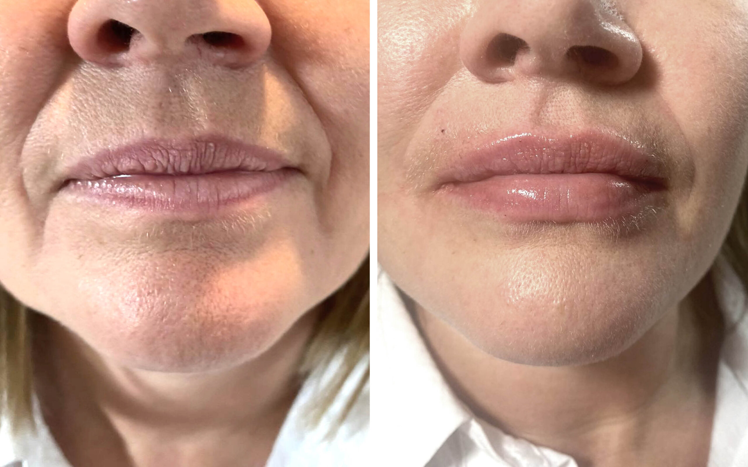 lip filler treatment