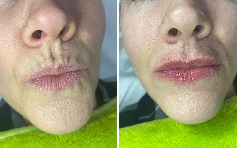 Dermal fillers warrington