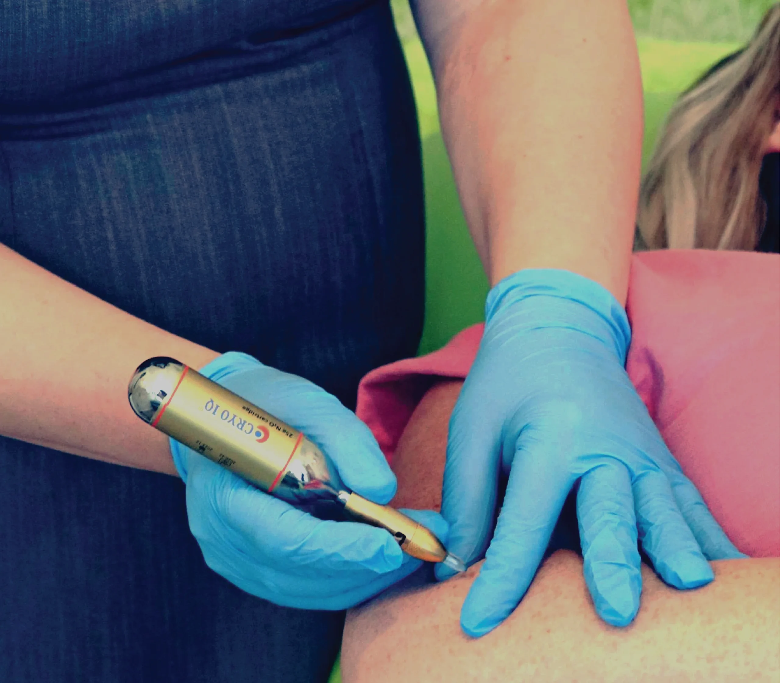 Cryotherapy Evolution Aesthetics Latchford Warrington